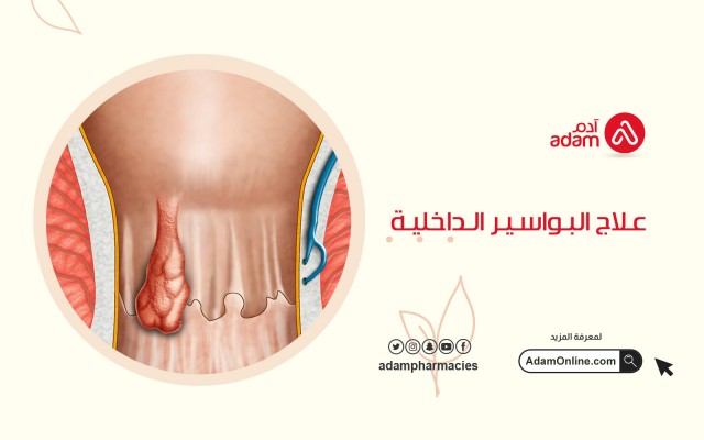 Treatment of internal hemorrhoids